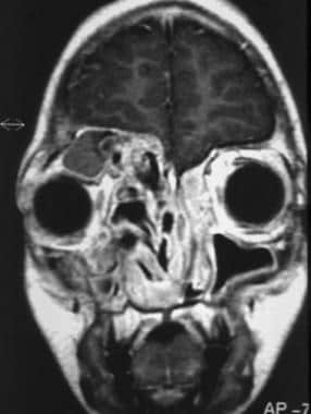 Coronal MRI scan showing expansion of the sinuses 