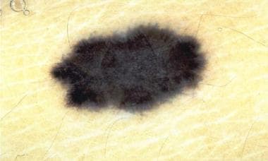 Whitish blue veil in a pigmented Spitz nevus. 