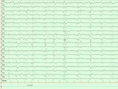 Generalized periodic epileptiform discharges (GPED