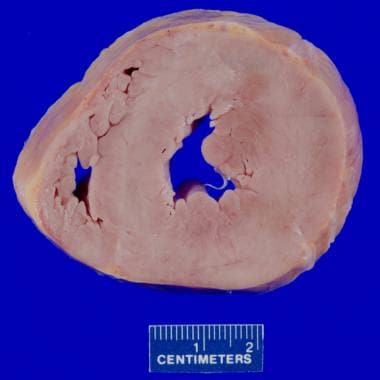 Cardiomegaly (220 g) and symmetric left ventricula