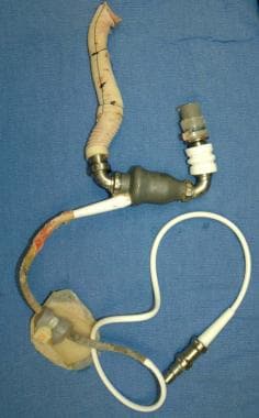 A photograph showing a ventricular assist device a