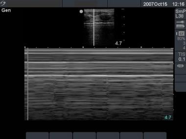 M-mode ultrasonography showing stratosphere sign, 