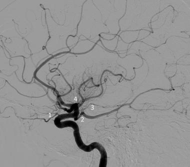 Lateral projection of a left common carotid artery
