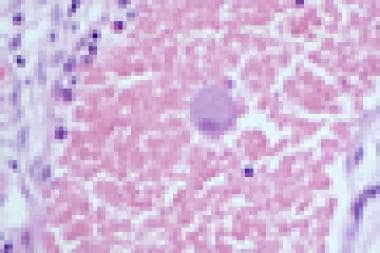 Characteristic giant cell with inclusion body in a