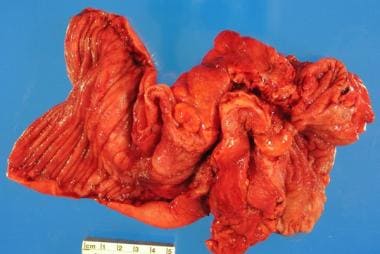Opened small bowel in a patient with Crohn disease