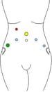 Proctocyle Pelvic Prolapse: Diagnosing and Treating Cystoceles, Rectoceles, and ...