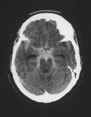 CT scan of aneurysmal subarachnoid hemorrhage in 5