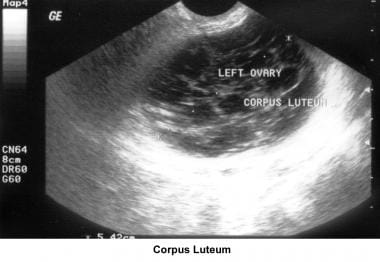 Infertility. Corpus luteum. Image courtesy of Jair