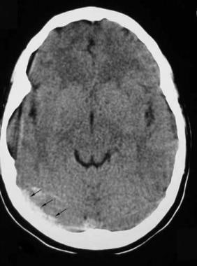 A noncontrast CT image located demonstrates thromb