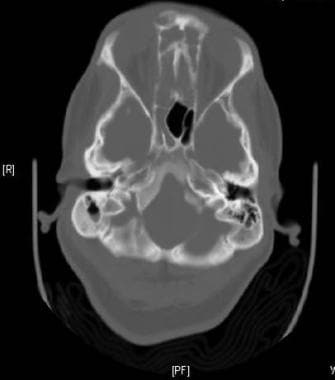 Osteolysis CT: Axial CT at the base of the skull w