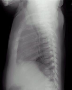 Radiograph of an infant with tetralogy of Fallot (
