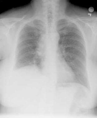 Lung cancer, small cell. Frontal chest radiograph 