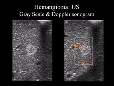 Gray-scale and Doppler ultrasonographic (US) image