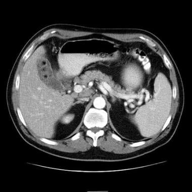 Cholelithiasis. Contrast CT demonstrates multiple 