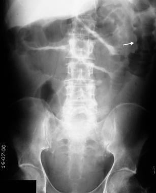Plain abdominal radiograph in a 65-year-old man pr