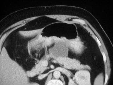 CT scan of a large symptomatic pancreatic pseudocy