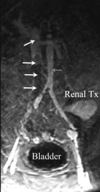 Magnetic resonance angiogram (MRA) in a renal tran