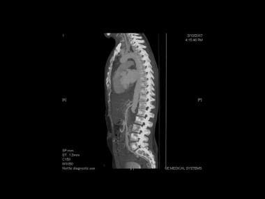 Image of a 39-year-old man with Leriche syndrome. 