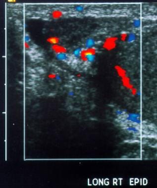 Normal testis and epididymis. Longitudinal color D