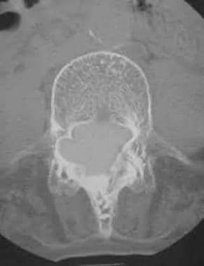 Dural ectasia. Axial postmyelographic CT scan show