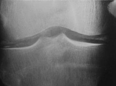Anteroposterior radiograph of knee. Radiodense lin