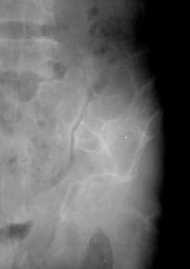 Radiograph of brown tumors of the pelvis in a pati
