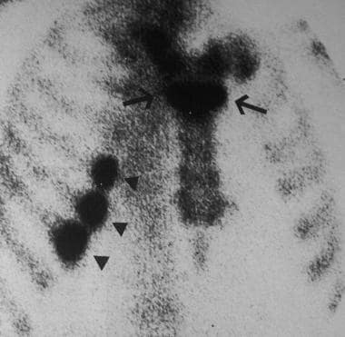 Nuclear bone scan of fractures of the sternum (arr