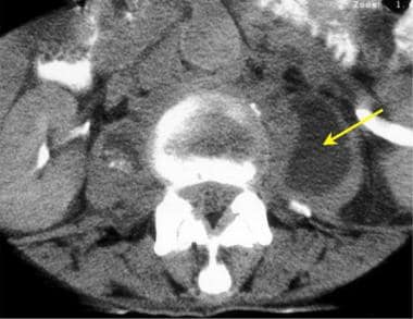 Thoracic spine trauma. Axial CT image in a man wit