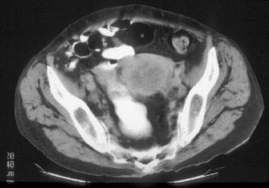 CT of a patient with stage IVB cervical carcinoma 
