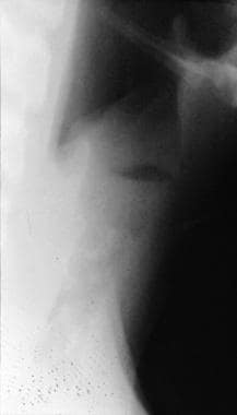 Lateral radiograph in a patient with membranous cr