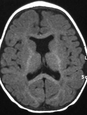 Axial T1-weighted magnetic resonance image shows s