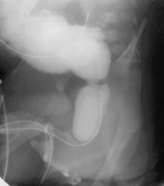 Sagittal voiding image of the bladder and urethra 