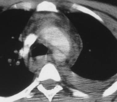 Aorta, trauma. CT scan shows aortic disruption at 