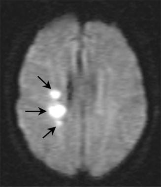 轴向t1加权弥散MRI显示3亚段