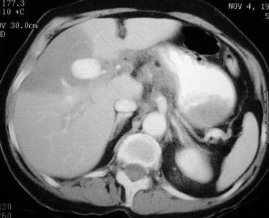 Contrast-enhanced CT of a 65-year-old woman with a