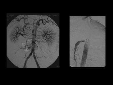 Angiogram of the same patient as in the previous i