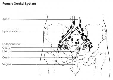 Line drawing of a woman's pelvic area showing the 