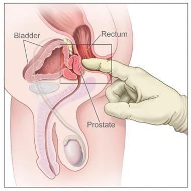 psa test prostate cancer wiki