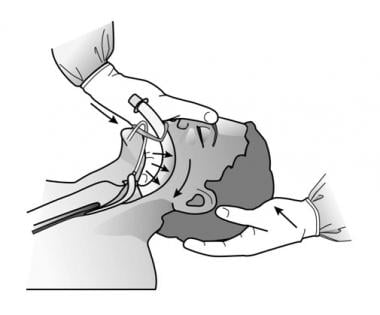 Laryngeal Mask Airway: Overview, Indications, Contraindications