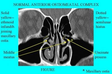 Uncinate shop process nose