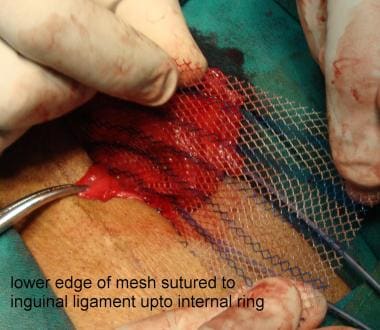 Open inguinal hernia repair. Lower edge of mesh su