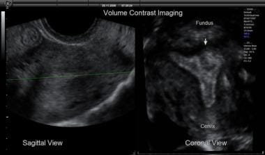 Volume contrast imaging showing sagittal view of t