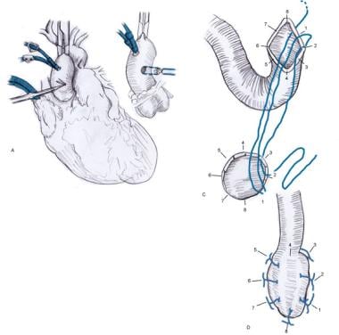 Coronary Artery Bypass Grafting. Illustration of t