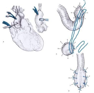 Diabetes, Multivessel CAD, and LV Dysfunction? Registry Analysis Gives CABG  the Edge Over PCI