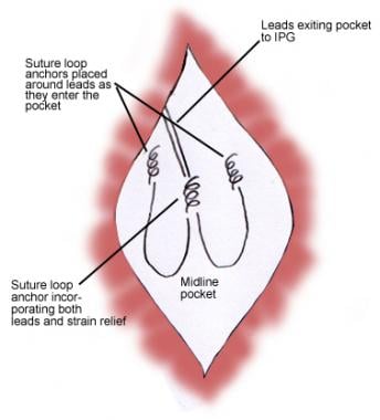 Midline pocket suture.