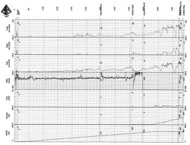 What is normal intra-abdominal pressure and how is it affected by  positioning, body mass and positive end-expiratory pressure?