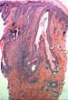 Folliculitis