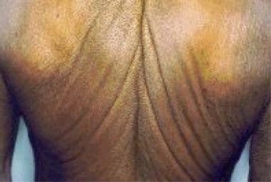 Prominent skin laxity and wrinkling on the back. 