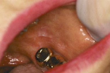 Leukoplakialike lesion in a patient who is allergi