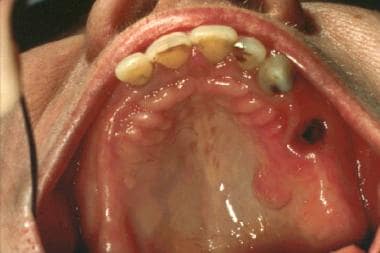 Solitary neurofibroma on the hard palate.